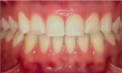 SureSmile® prej in potem